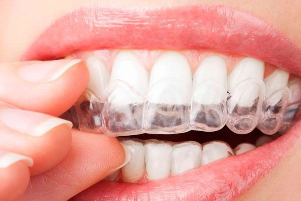 Branqueamento Dentário